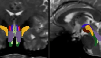 AI відкриває стовбур мозку: BrainStem Bundle Tool сегментує 8 пучків на дифузійній МРТ — що це змінює для діагностики?